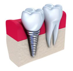 dental implants shippensburg pa 