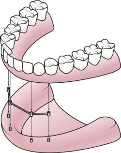 all on four dental implant shippensburg pa